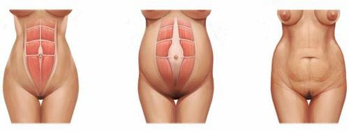 Schemat mięśni brzucha u kobiet w ciąży