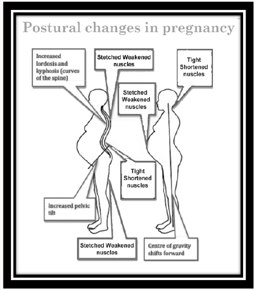 zmiany postury w ciąży